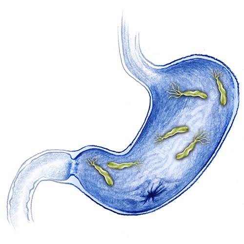 PREVALENCE OF HELICOBACTER PYLORI AMONG STUDENTS OF DR. JOHN ADAH COLLEGE OF HEALTH TECHNOLOGY OTUKPO, BENUE STATE NIGERIA.